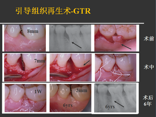 侯建霞 牙周病学高级班