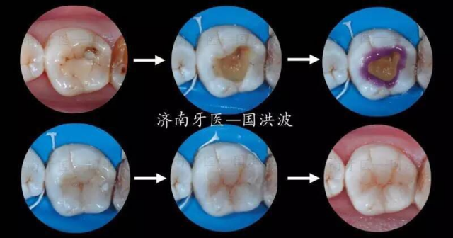 美学树脂修复技术实操培训班