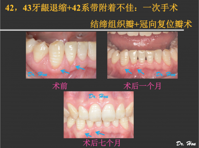 侯建霞 牙周病学高级班