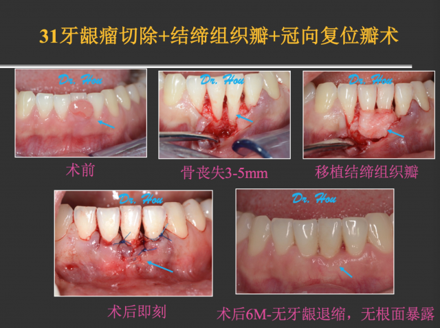 侯建霞 牙周病学高级班