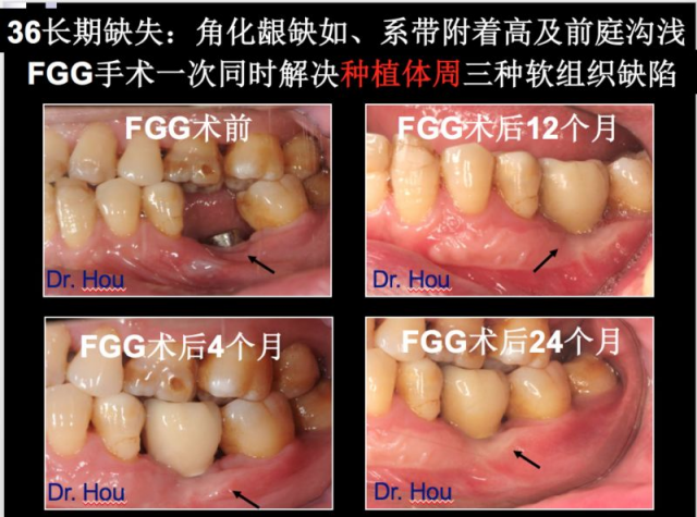 侯建霞 牙周病学高级班