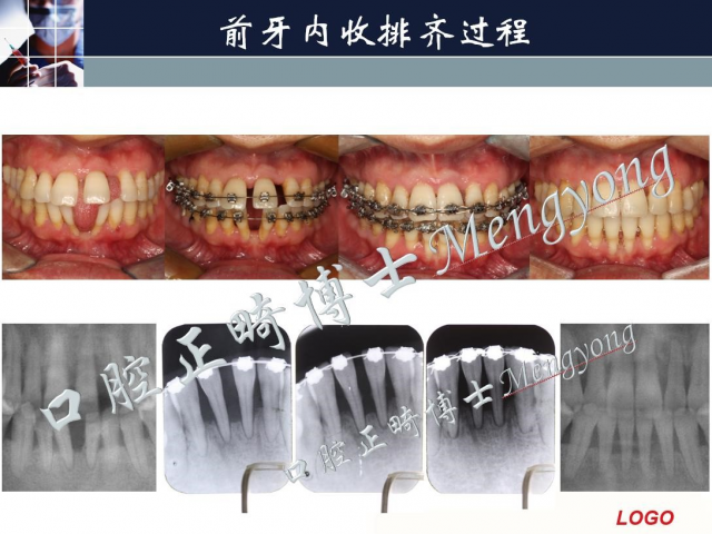 孟勇 正畸实战系统课程之直丝矫治技术篇