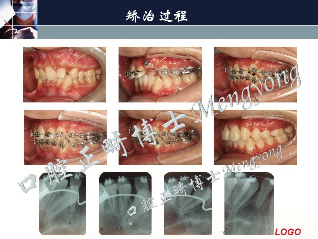 孟勇 从入门到精通--正畸实战系统课程