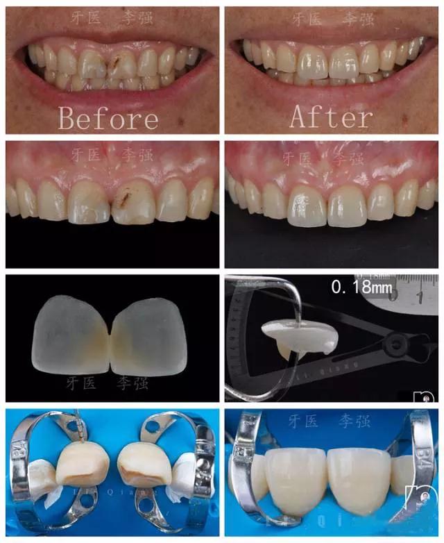 李强老师《DSD设计瓷贴面嵌体规范化操作实操班》