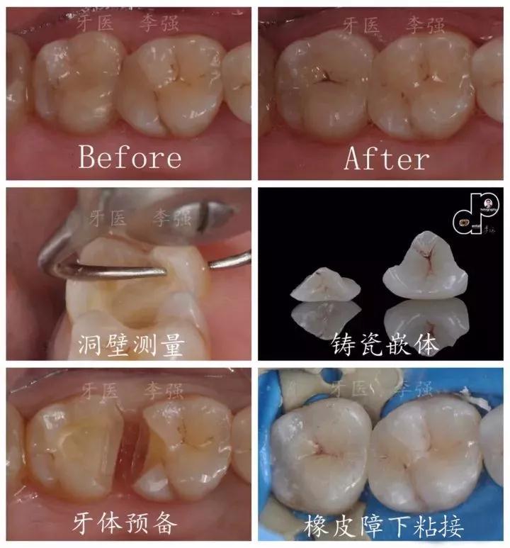 李强老师《DSD设计瓷贴面嵌体规范化操作实操班》