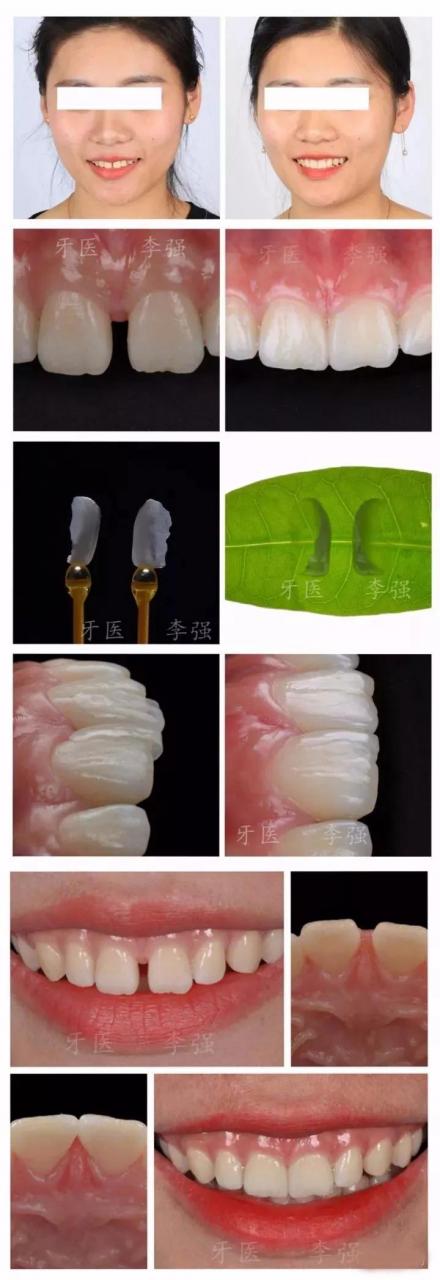 李强老师《DSD设计瓷贴面嵌体规范化操作实操班》