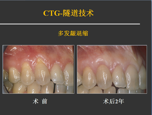 侯建霞 牙周病学高级班 11月上海